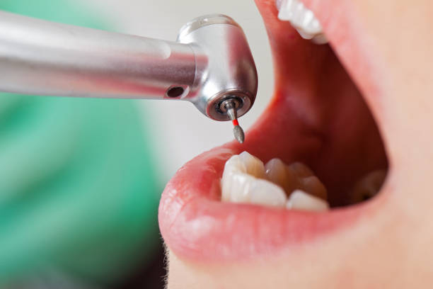 Best Chipped Tooth Repair Near Me  in Oak Leaf, TX